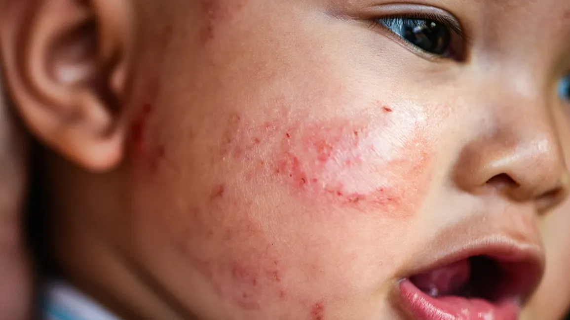 Baby Eczema: Symptoms, Causes, and Treatment Tips for Happier Skin